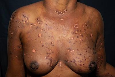 Case Report: The many faces of bullous pemphigoid